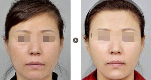 寧波果酸煥膚祛痘印專(zhuān)業(yè)醫(yī)院排行榜及口碑調(diào)查