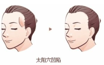 長(zhǎng)沙哪家整形醫(yī)院做隆鼻技術(shù)好？湖南人民醫(yī)院實(shí)力醫(yī)生坐診質(zhì)量咋樣？