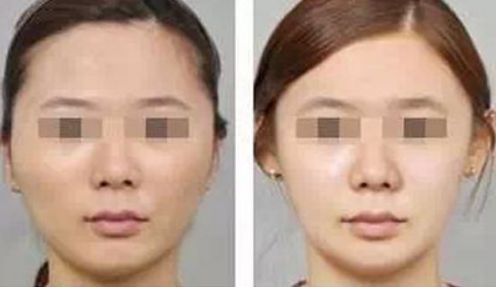 長春市哪家醫(yī)院牌子好的植發(fā)手術(shù)效果可靠