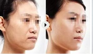 【上海娜美醫(yī)療美容】程旭醫(yī)生隆胸效果如何？委托的醫(yī)院有哪些？