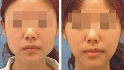 【持續(xù)關(guān)注】成都潤美玉之光隆胸效果如何？真實(shí)用戶分享體驗(yàn)