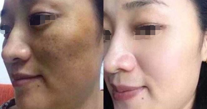 衡陽干細(xì)胞祛淚溝整形，10家醫(yī)院技術(shù)領(lǐng)先，實(shí)力大比拼