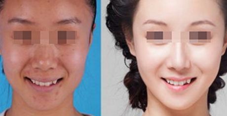 上海整形外科醫(yī)生潘偉的隆胸技術(shù)與經(jīng)驗分享