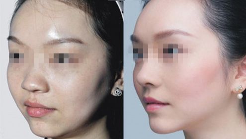 上海哪里的整形醫(yī)院隆胸效果好，醫(yī)生經驗豐富？