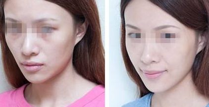 新疆熱瑪吉去抬頭紋首選10大口碑美容院推薦