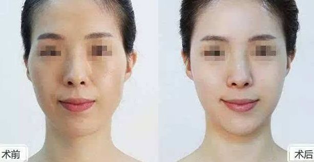 優(yōu)質(zhì)寧波眼角紋線雕美容醫(yī)院推薦：這份榜單不容錯(cuò)過