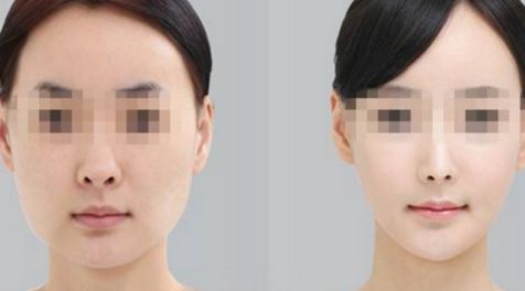 南寧背部脂肪溶解技術(shù)排行榜！最受歡迎的整形醫(yī)院推薦