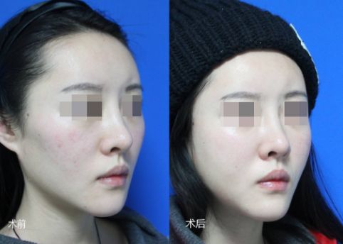 北京哪家醫(yī)院的隆胸效果比較好？