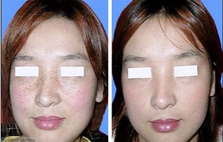 沈陽口碑前十好去處：高效去紋身，重塑無痕新肌