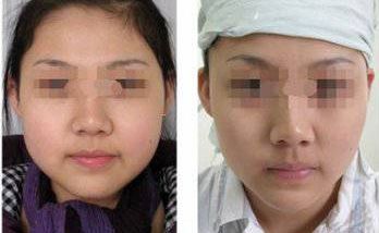 深圳鼻基底耳軟骨填充醫(yī)院口碑排行榜，前十強(qiáng)揭曉！