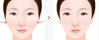 長沙除皺針祛眼角皺紋醫(yī)院推薦：專業(yè)機構選擇指南