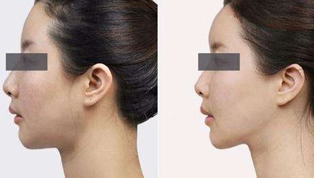 上海離子負壓祛眼袋整形良心醫(yī)院推薦