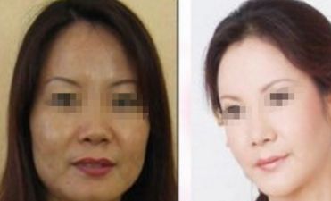 唐志榮教你輕松實(shí)現(xiàn)理想隆胸，還擅長(zhǎng)眼鼻整形