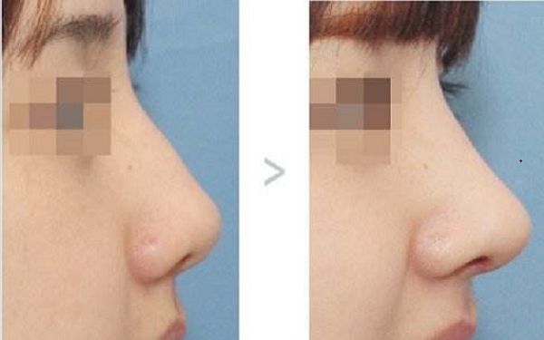 上海激光去靜態(tài)紋哪家好？這十家醫(yī)院口口相傳！