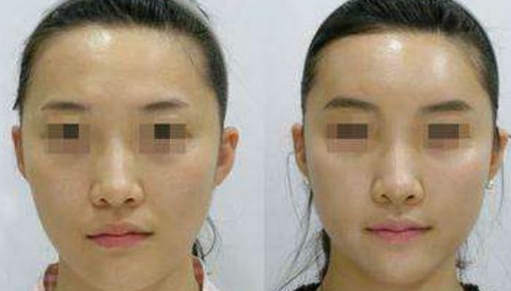 揚州玻尿酸魚尾紋淡化醫(yī)院排行榜，年輕由你掌控