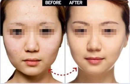 長(zhǎng)沙痘痕磨削手術(shù)醫(yī)院推薦：專業(yè)評(píng)價(jià)前十家