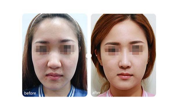 太原隆鼻尖整形美容醫(yī)院排名前十強！同城精選，助你找到最合適的醫(yī)院！