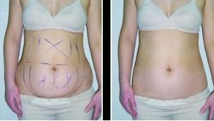 煙臺靜態(tài)紋去除哪家整形醫(yī)院口碑最佳？Top10排名揭曉