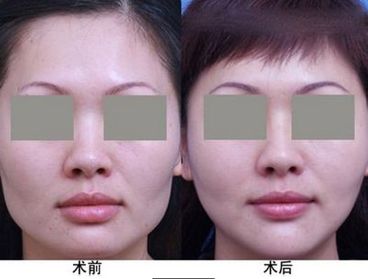 西安光電去除淚溝正規(guī)整形醫(yī)院排行榜揭秘！