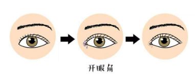 南京東南眼科丨近視手術(shù)價(jià)格指南：激光手術(shù)全解析