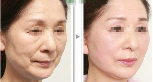 濟(jì)南玻尿酸胸部填充美容醫(yī)院排名TOP10，口碑好評(píng)精選！