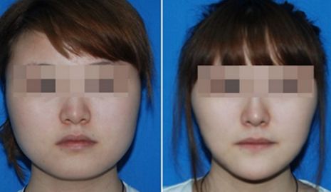 滁州眼角紋去除，整形醫(yī)院排名揭曉！