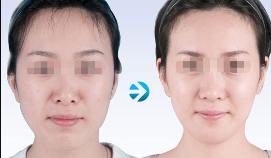 廣州眼角皺紋去除醫(yī)療美容排名分析：前10家醫(yī)院技術(shù)對(duì)比