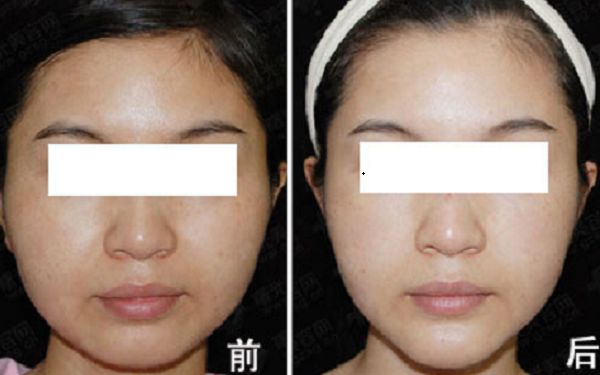 深圳腋臭手術(shù)醫(yī)院排行榜，光纖無痛除腋臭