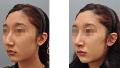 成都肉毒素抗皺權(quán)威榜單，十家口碑醫(yī)院大解密