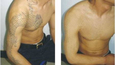 深圳哪家醫(yī)院玻尿酸填充肥胖紋效果好？排名前十強(qiáng)醫(yī)院揭秘