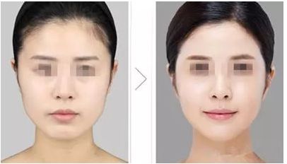 深圳豐胸整形醫(yī)院權(quán)威排行榜