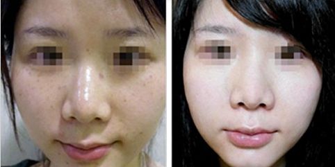 南通自體脂肪墊額頭整形醫(yī)院權(quán)威排名