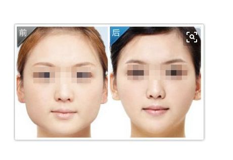 軟骨隆鼻的優(yōu)勢：效果、滿意度及相關信息一覽