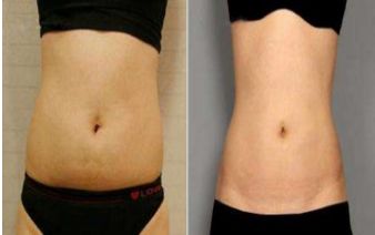 西安哪家醫(yī)院膠原蛋白填充額頭紋效果好？排行榜揭曉！