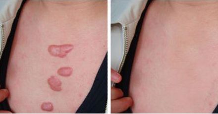 武漢日式無(wú)痕微創(chuàng)拉皮術(shù)實(shí)力排名榜單