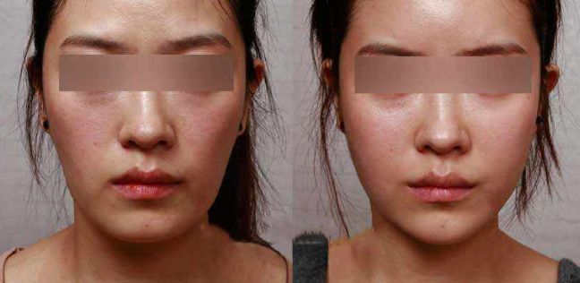 河南韓式雙眼皮修復(fù)醫(yī)院排名榜單出爐！口碑爆棚的前十大醫(yī)院揭秘