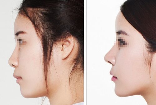 成都哪里可進(jìn)行蘋(píng)果肌填充手術(shù)？醫(yī)科大學(xué)非直屬附屬區(qū)域值得考慮