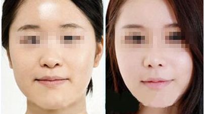 海口舌側矯正，選徐普主任醫(yī)師教授碩士生導師怎么樣？