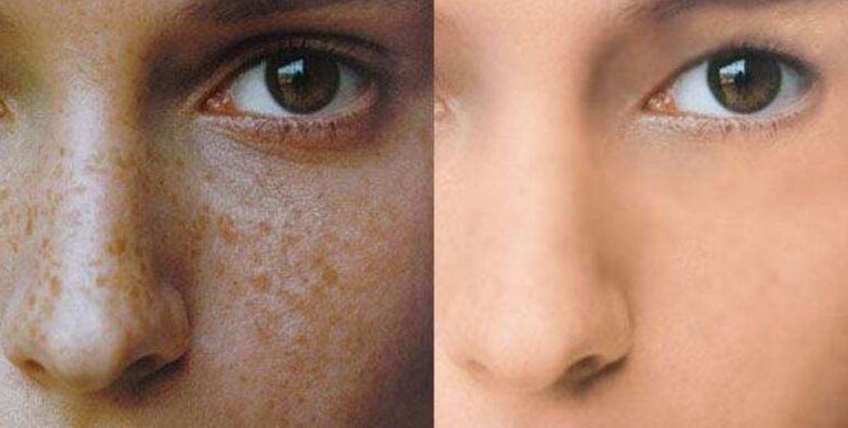 不整齊牙齒怎么辦？嘗試黃金舌側矯正，輕松迎接自信笑容！