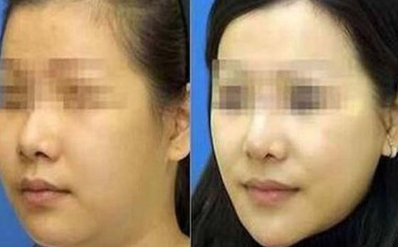 無錫哪家醫(yī)院治療眼角紋效果好？前十強醫(yī)院排名揭秘！