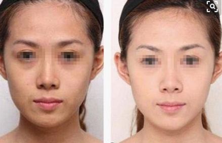 劉成勝自體脂肪隆胸手術(shù)費(fèi)用、手術(shù)效果及患者評(píng)價(jià)概述