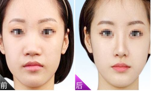 南京自體脂肪整形醫(yī)院哪家好？脂肪豐胸醫(yī)院排名榜單!