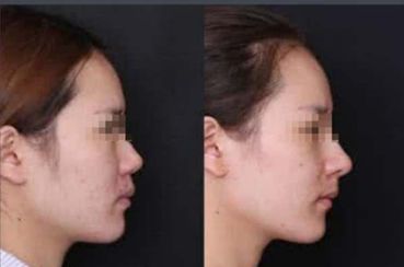 自體脂肪填充：剖析風險與禁忌事項！