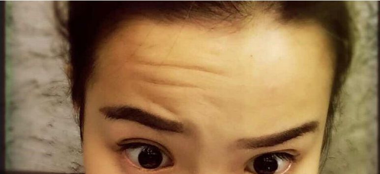 自體脂肪移植：法令紋填充的有效整形方式及注意事項(xiàng)