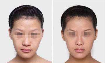 廣州哪家假體隆胸醫(yī)院評(píng)價(jià)比較好？廣州隆胸手術(shù)哪里好？廣州隆胸手術(shù)醫(yī)院榜單出爐！廣州假體隆胸哪家醫(yī)院好