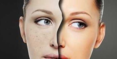 黑龍江哪家醫(yī)院自體脂肪填充痘疤效果好？排行榜前10家推薦