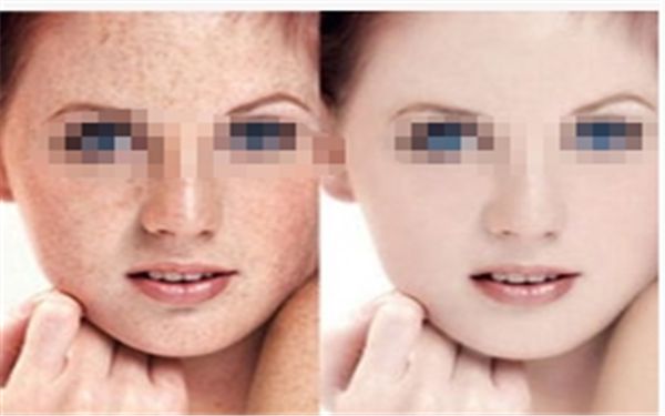 佛山哪家醫(yī)院治療眼部膠原蛋白豐淚溝效果好？排名前幾強(qiáng)？