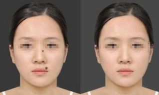 汕頭鐳射激光開(kāi)眼角醫(yī)院排名TOP榜單