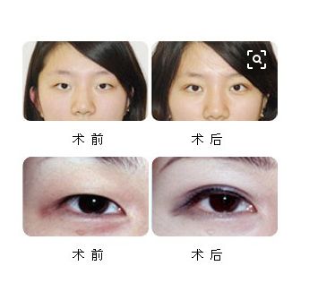 上海韓式微創(chuàng)重瞼整形醫(yī)院人氣排名大曝光
