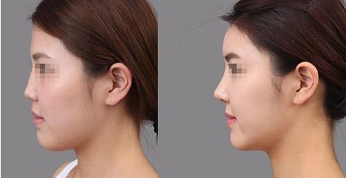 2023年蘭州填充脂肪的醫(yī)院，排行榜揭曉